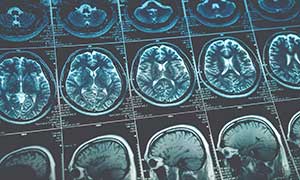 MRI image of brain
